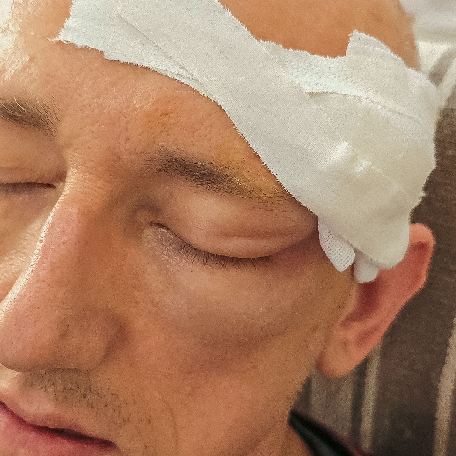 AJ Donnelly 3 days after skin cancer removal surgery